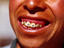 Fillings on teeth, Guatemala