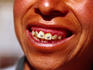 Bronze and gold star cavity fillings on teeth of indigenous man.
